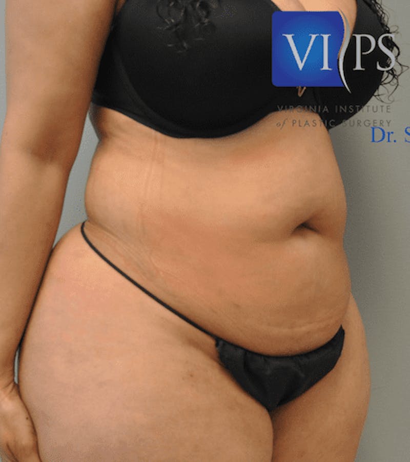 JPlasma Before & After Gallery - Patient 55345203 - Image 1