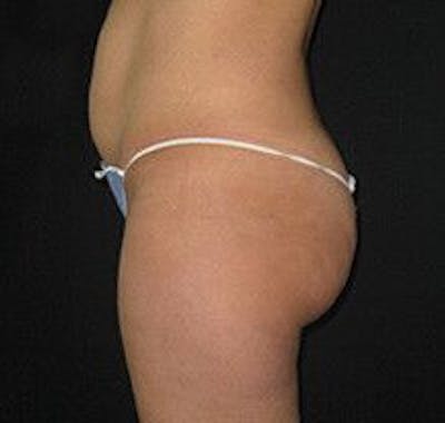UltraShape Before & After Gallery - Patient 55345182 - Image 2