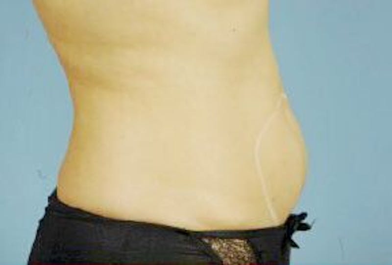truSculpt Before & After Gallery - Patient 55345198 - Image 1