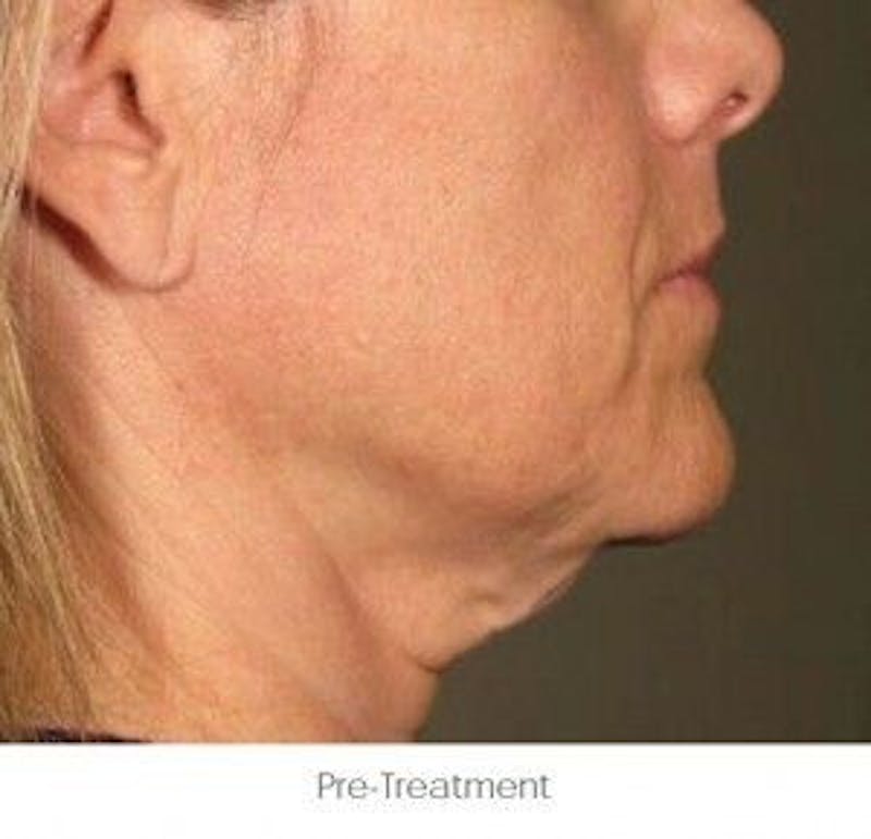 Ultherapy Before & After Gallery - Patient 55345185 - Image 1