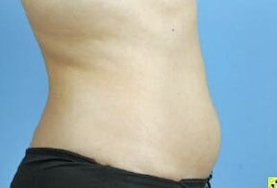 truSculpt Before & After Gallery - Patient 55345198 - Image 2