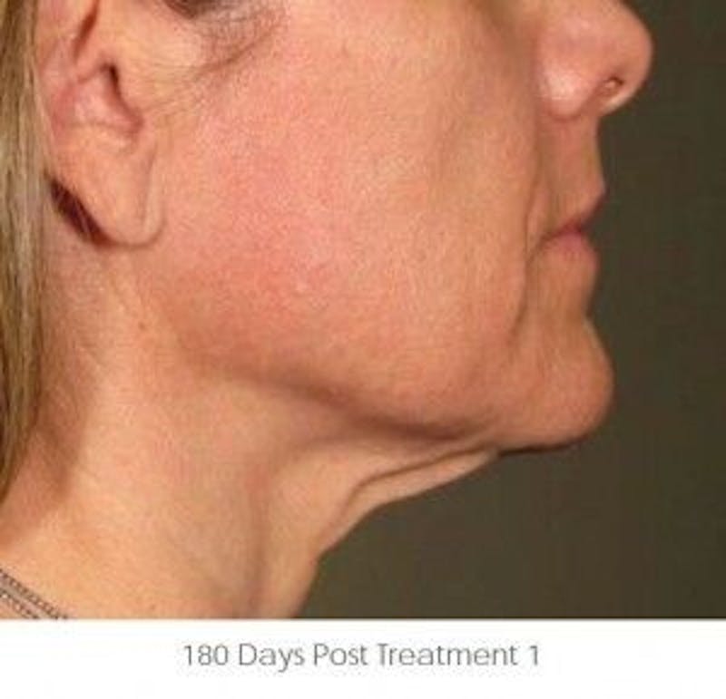 Ultherapy Before & After Gallery - Patient 55345185 - Image 2