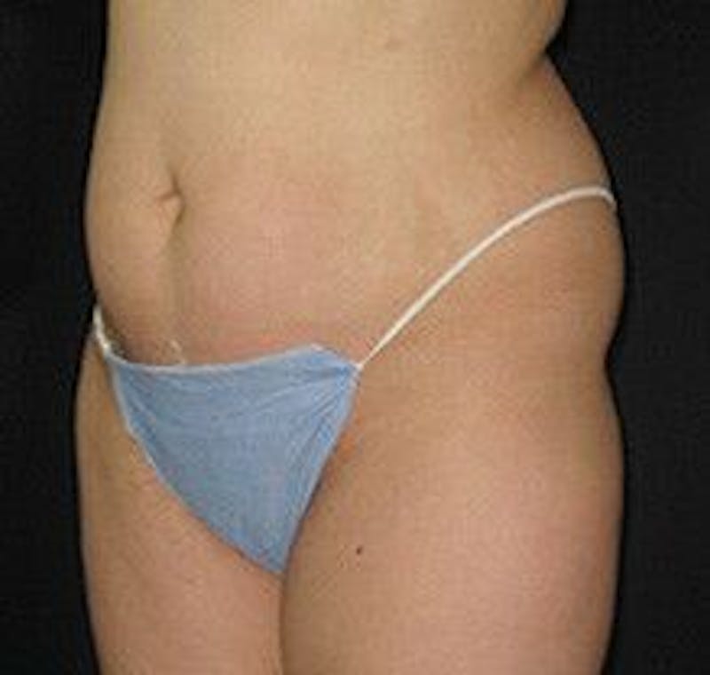 UltraShape Before & After Gallery - Patient 55345186 - Image 2
