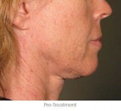 Ultherapy Gallery - Patient 55345191 - Image 1
