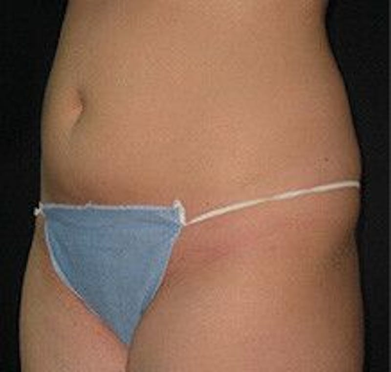 UltraShape Before & After Gallery - Patient 55345192 - Image 1