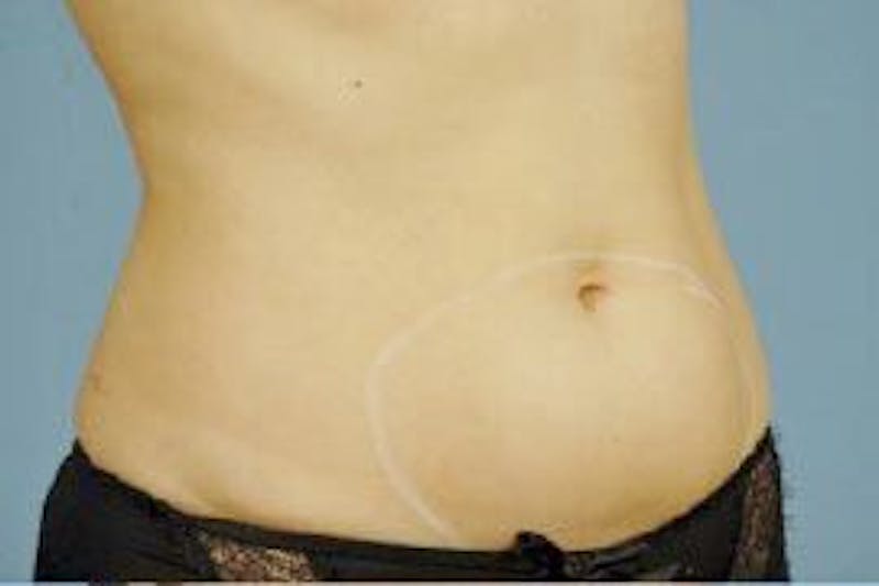 truSculpt Before & After Gallery - Patient 55345198 - Image 5