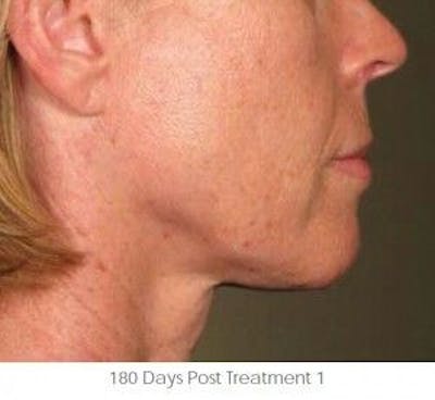 Ultherapy Gallery - Patient 55345191 - Image 2