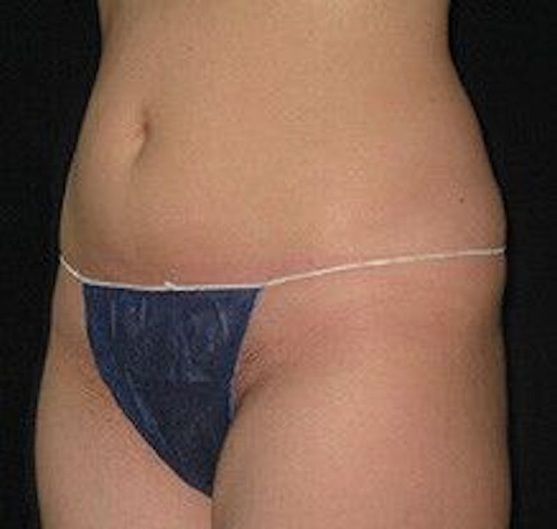 UltraShape Before & After Gallery - Patient 55345192 - Image 2