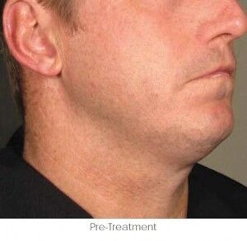 Ultherapy Before & After Gallery - Patient 55345197 - Image 1