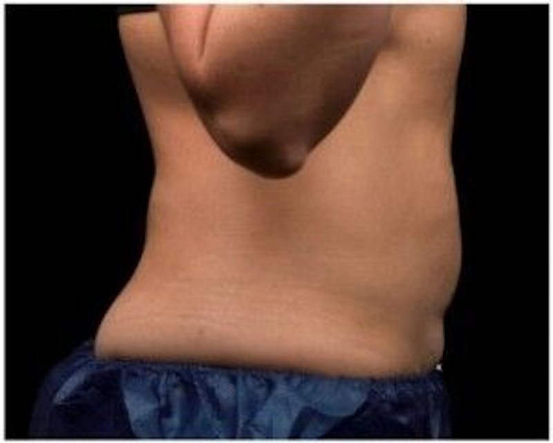Liposonix Before & After Gallery - Patient 55345196 - Image 2