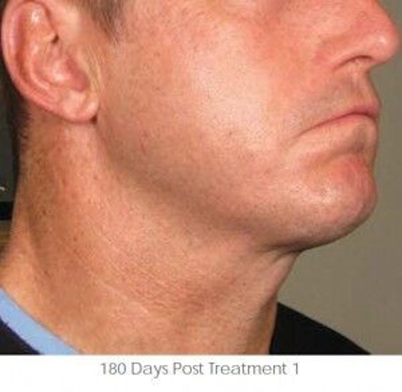 Ultherapy Before & After Gallery - Patient 55345197 - Image 2
