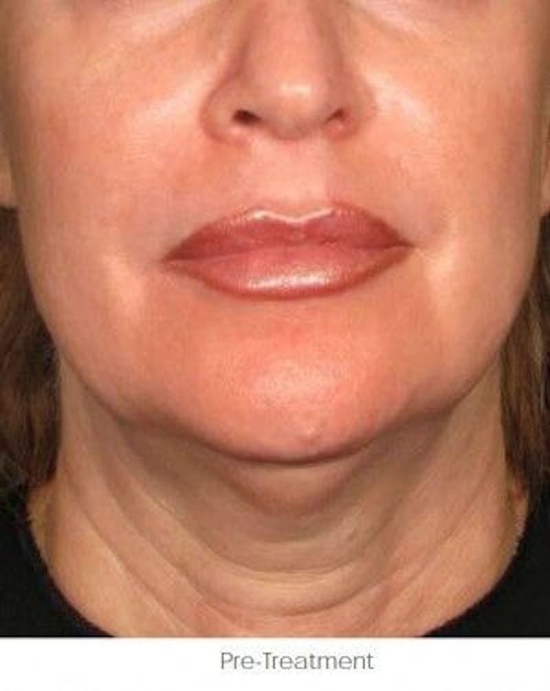 Ultherapy Before & After Gallery - Patient 55345202 - Image 1