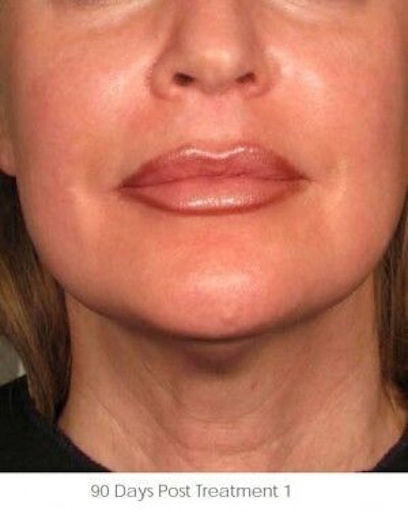 Ultherapy Before & After Gallery - Patient 55345202 - Image 2