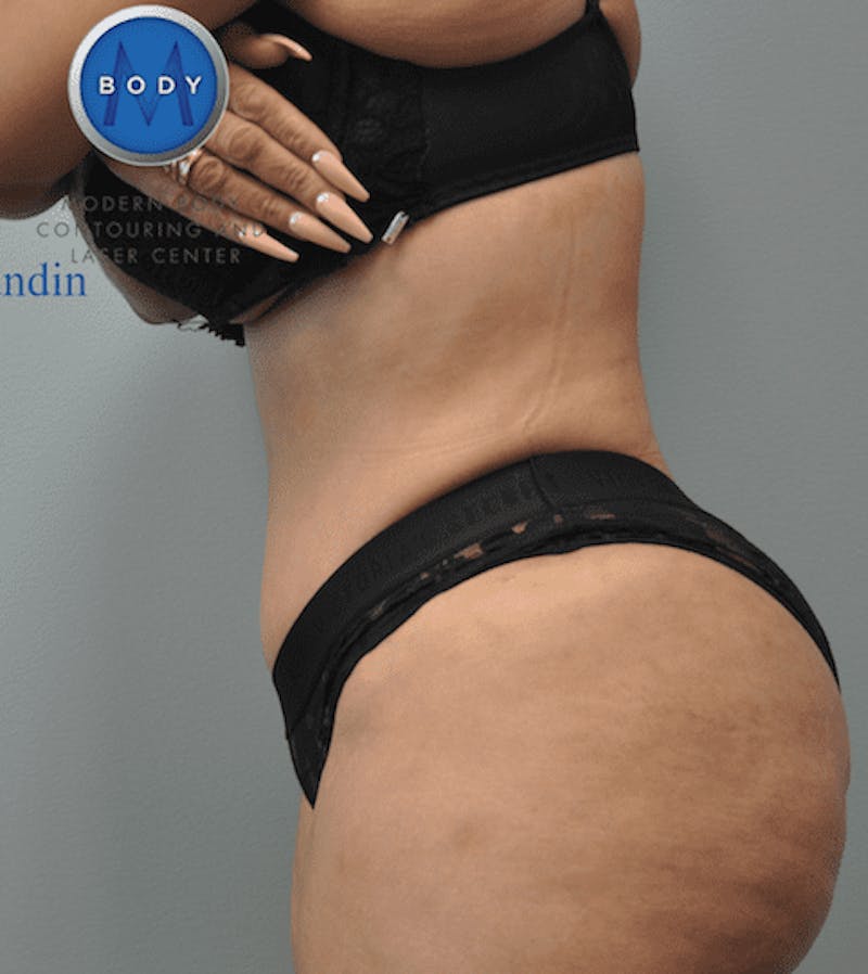 JPlasma Before & After Gallery - Patient 55345203 - Image 10