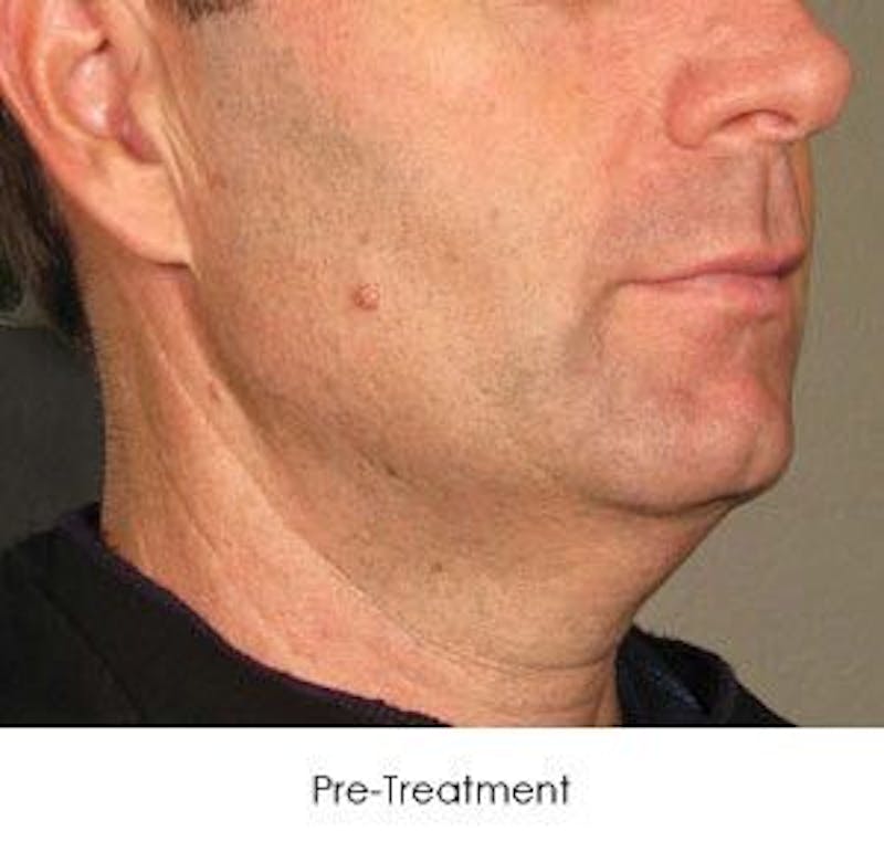 Ultherapy Gallery - Patient 55345206 - Image 1
