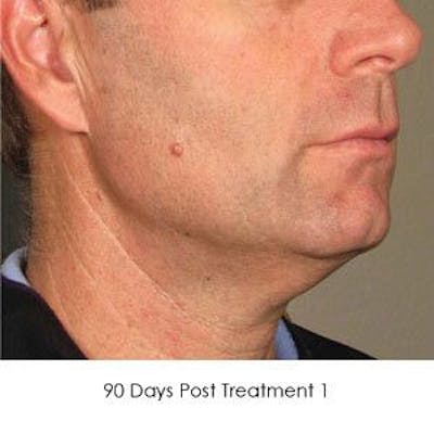 Ultherapy Before & After Gallery - Patient 55345206 - Image 2