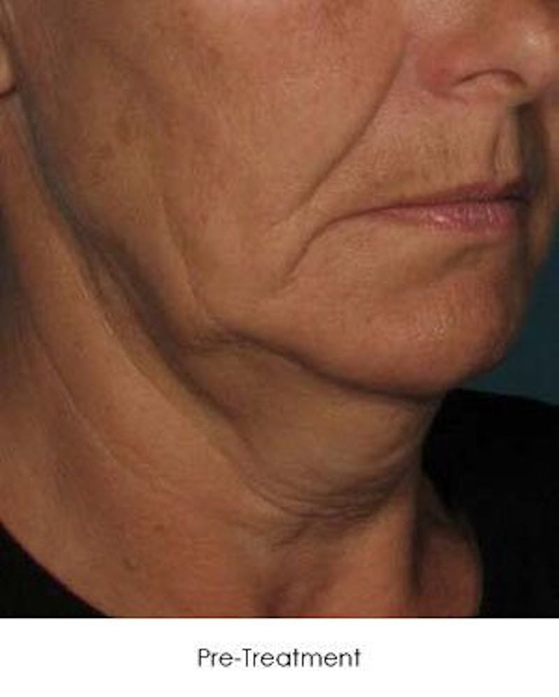 Ultherapy Before & After Gallery - Patient 55345210 - Image 1