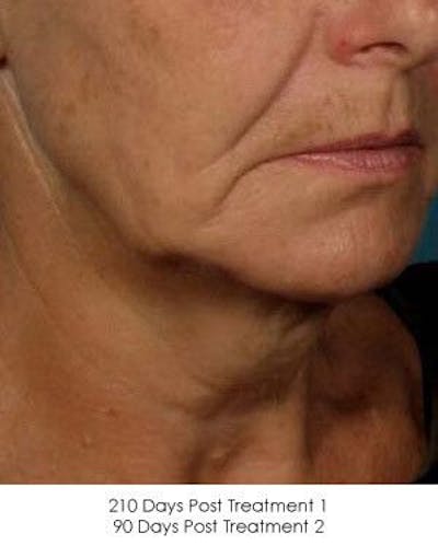 Ultherapy Before & After Gallery - Patient 55345210 - Image 2