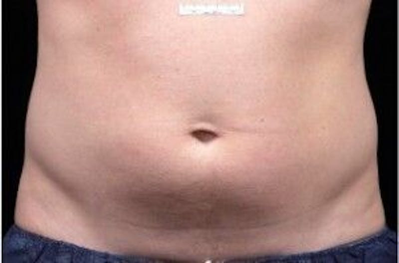 Liposonix Before & After Gallery - Patient 55345209 - Image 2
