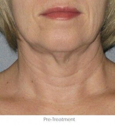 Ultherapy Before & After Gallery - Patient 55345212 - Image 1