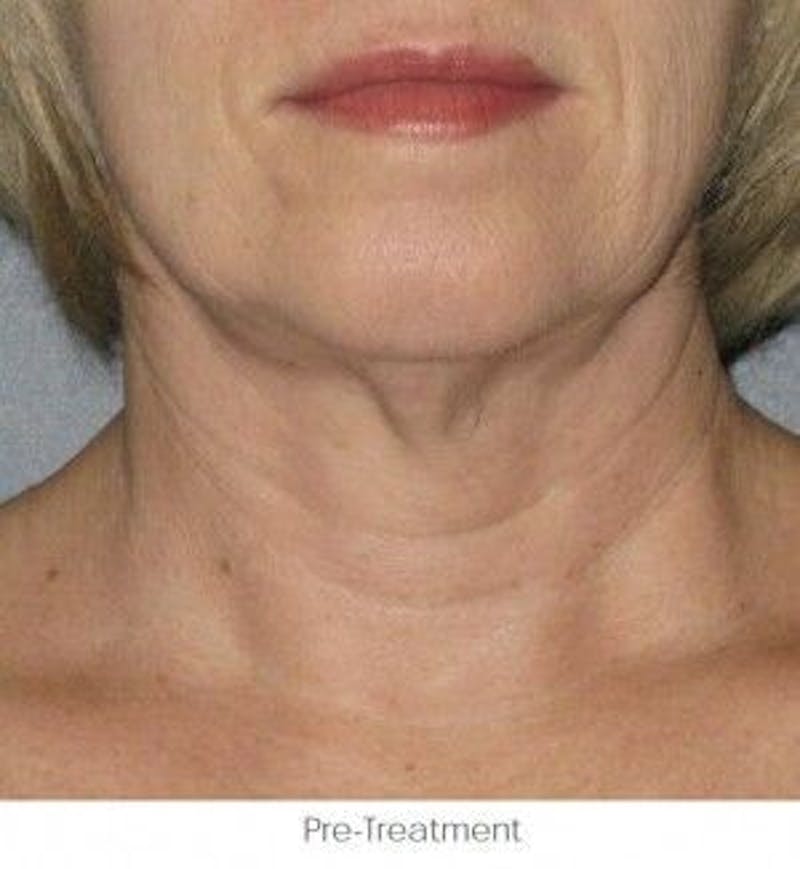 Ultherapy Before & After Gallery - Patient 55345212 - Image 1