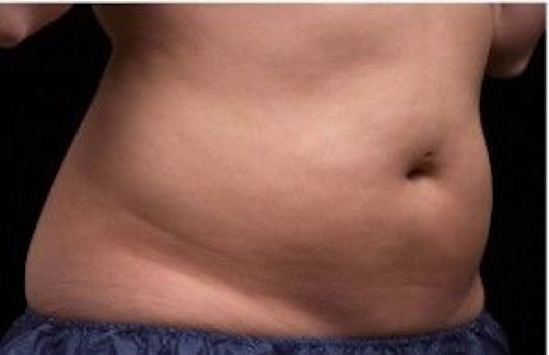 Liposonix Before & After Gallery - Patient 55345211 - Image 2