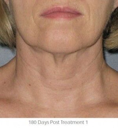 Ultherapy Before & After Gallery - Patient 55345212 - Image 2