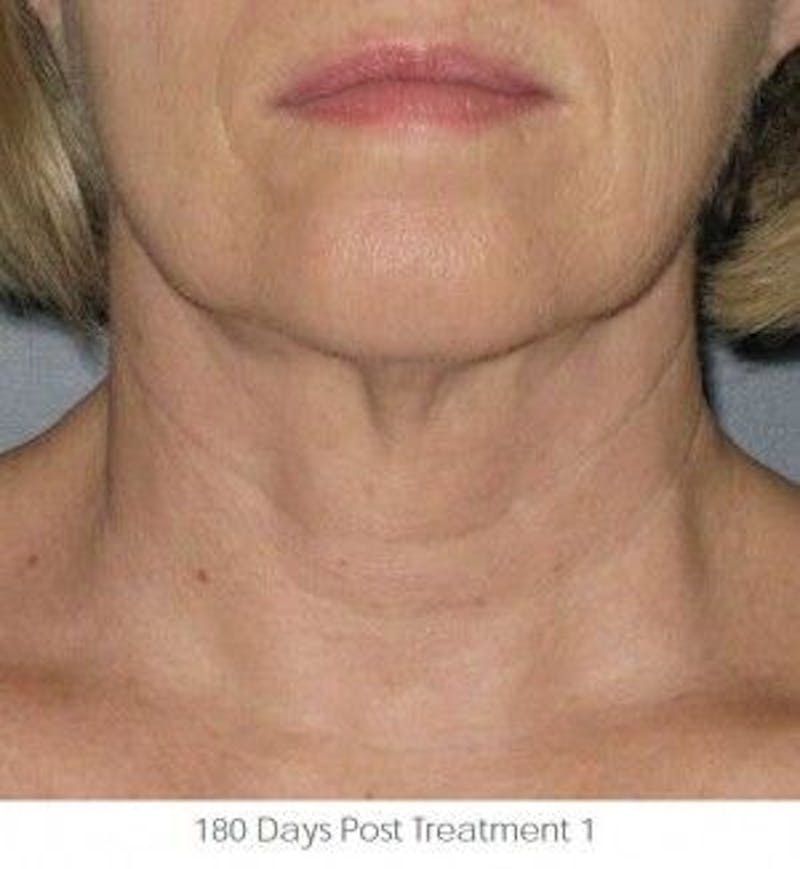 Ultherapy Before & After Gallery - Patient 55345212 - Image 2