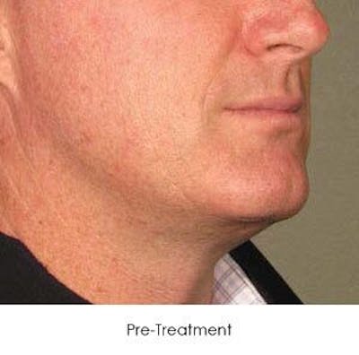 Ultherapy Before & After Gallery - Patient 55345216 - Image 1