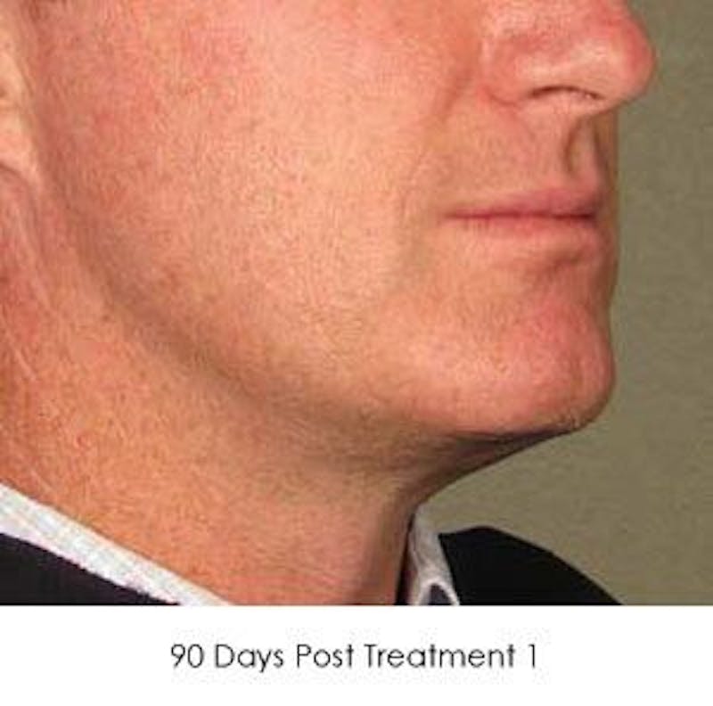 Ultherapy Before & After Gallery - Patient 55345216 - Image 2