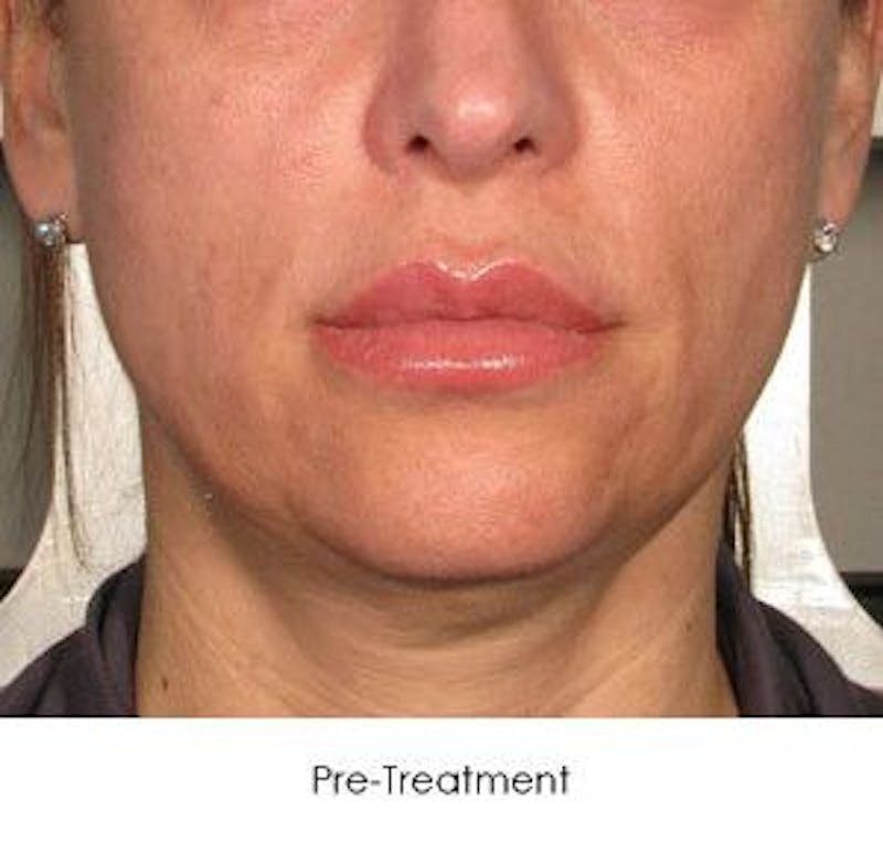 Ultherapy Before & After Gallery - Patient 55345220 - Image 1