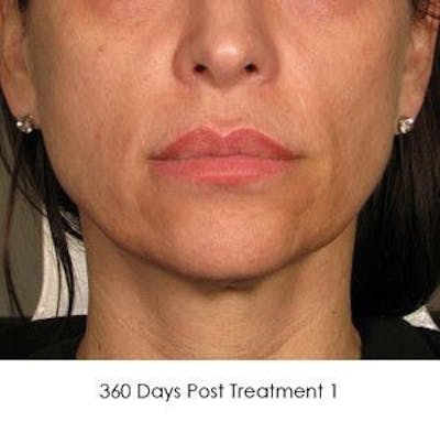 Ultherapy Before & After Gallery - Patient 55345220 - Image 2