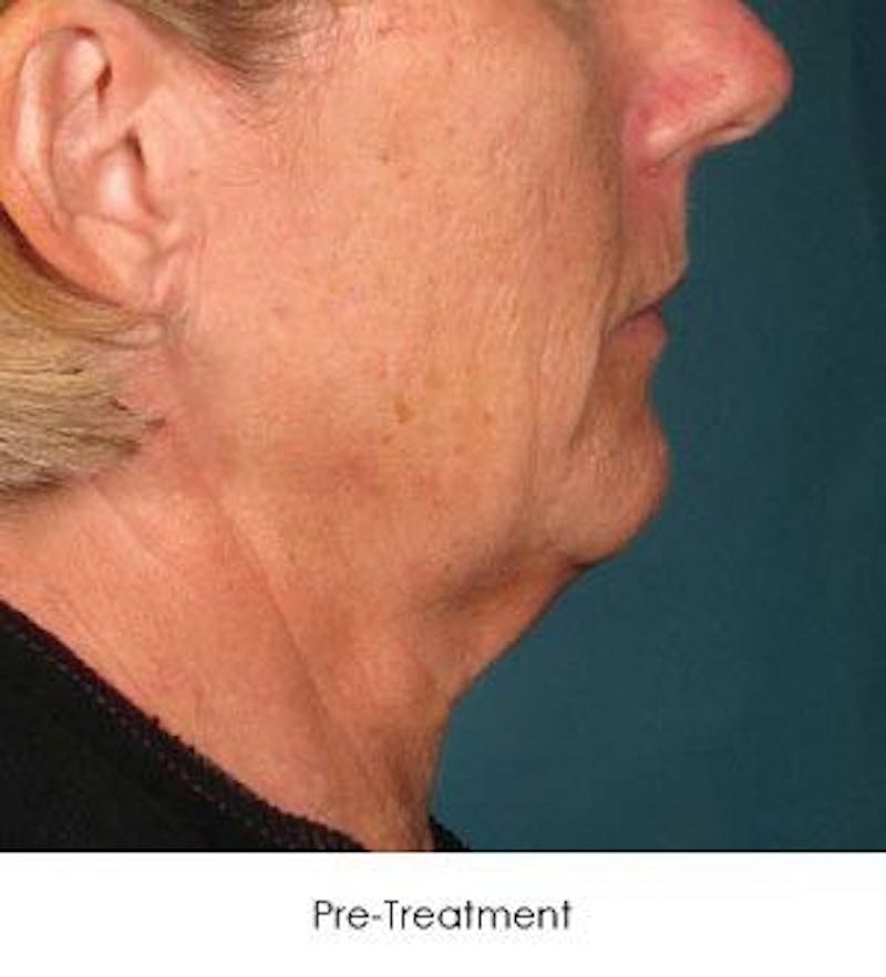 Ultherapy Before & After Gallery - Patient 55345221 - Image 1