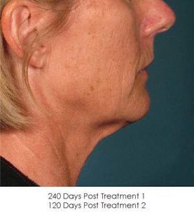 Ultherapy Before & After Gallery - Patient 55345221 - Image 2