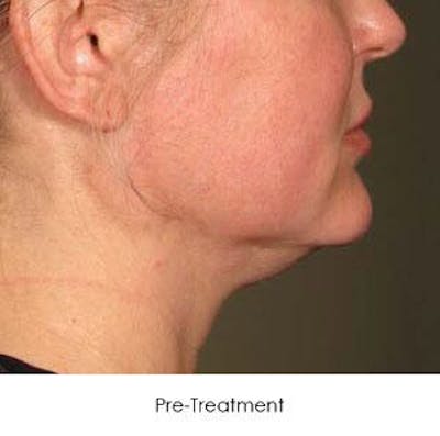 Ultherapy Before & After Gallery - Patient 55345222 - Image 1