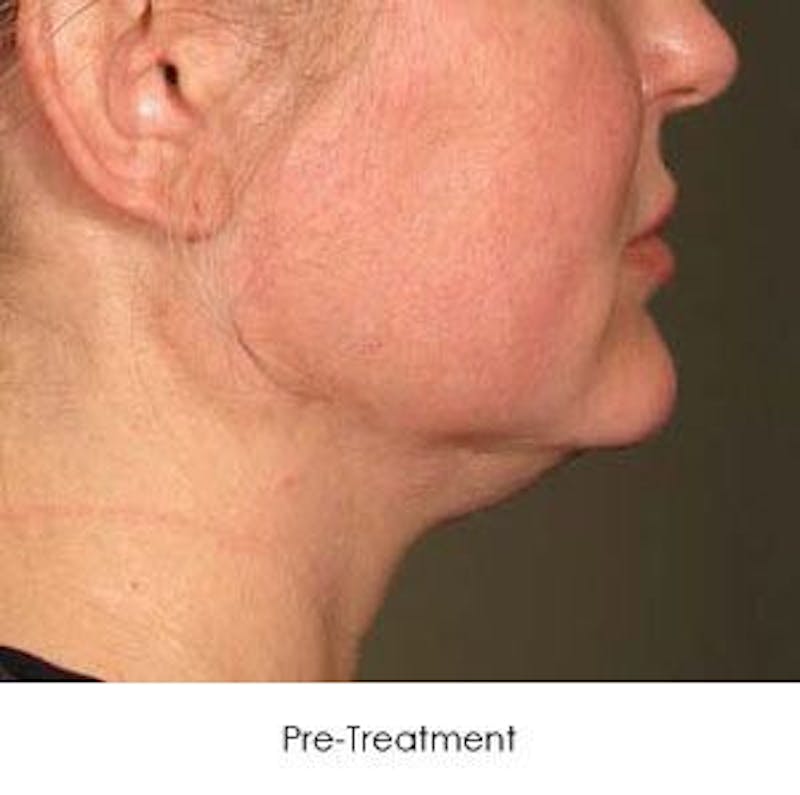 Ultherapy Before & After Gallery - Patient 55345222 - Image 1