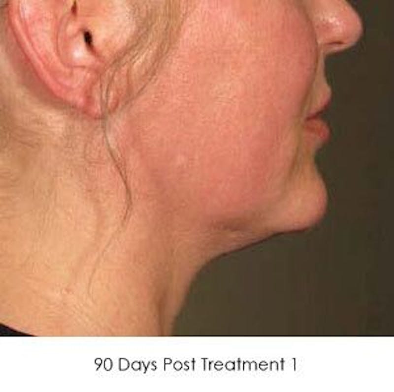 Ultherapy Before & After Gallery - Patient 55345222 - Image 2