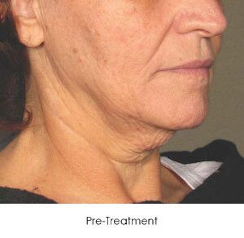 Ultherapy Before & After Gallery - Patient 55345239 - Image 1