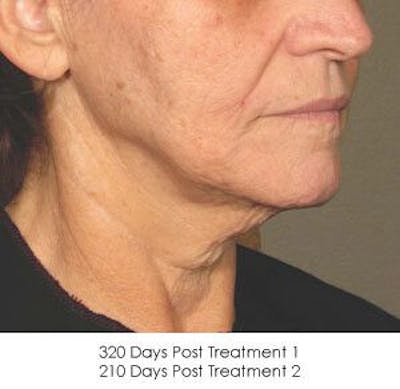 Ultherapy Before & After Gallery - Patient 55345239 - Image 2
