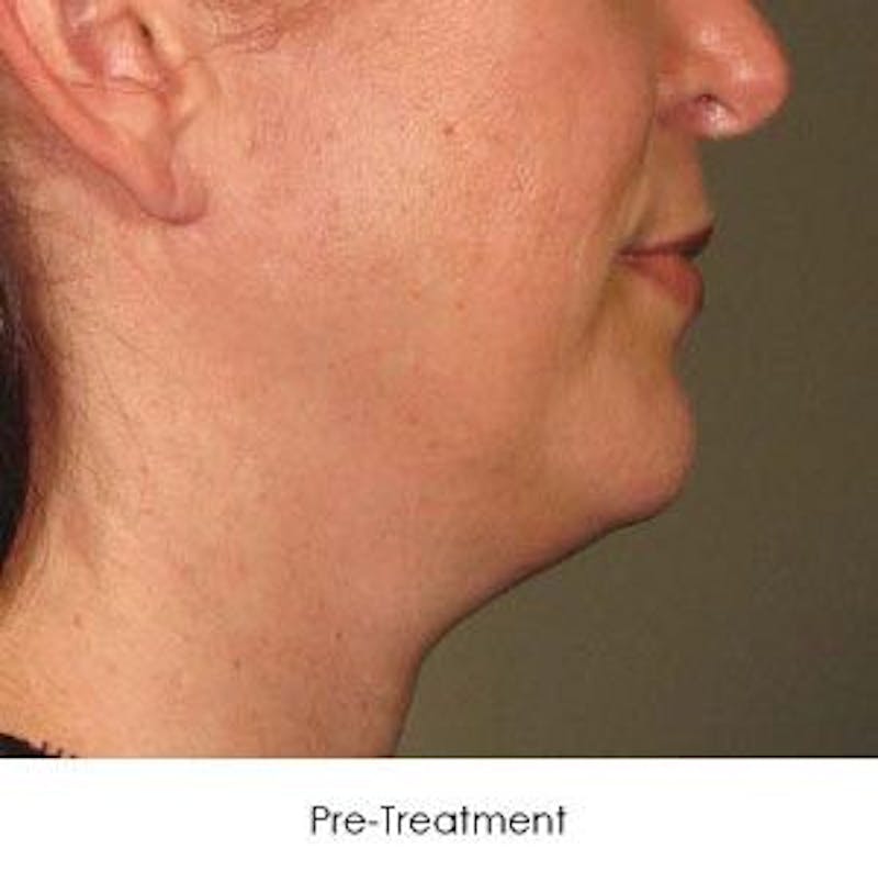 Ultherapy Before & After Gallery - Patient 55345253 - Image 1