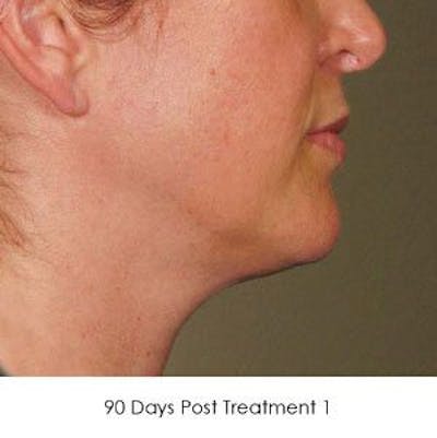 Ultherapy Before & After Gallery - Patient 55345253 - Image 2