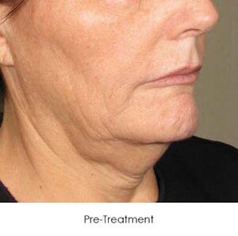 Ultherapy Before & After Gallery - Patient 55345258 - Image 1