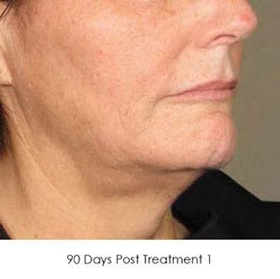 Ultherapy Before & After Gallery - Patient 55345258 - Image 2