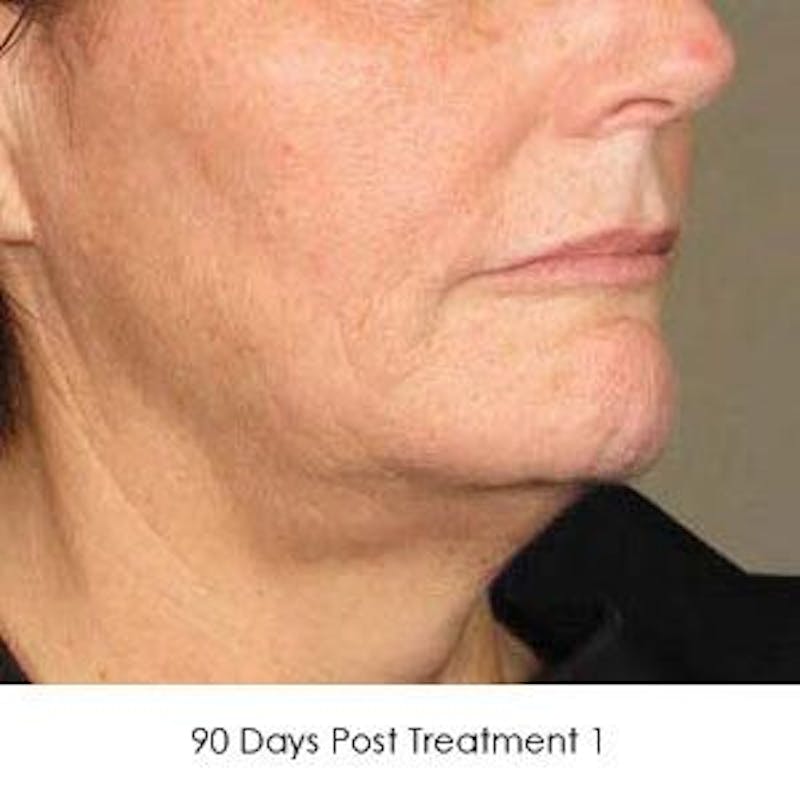 Ultherapy Before & After Gallery - Patient 55345258 - Image 2
