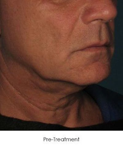 Ultherapy Before & After Gallery - Patient 55345259 - Image 1