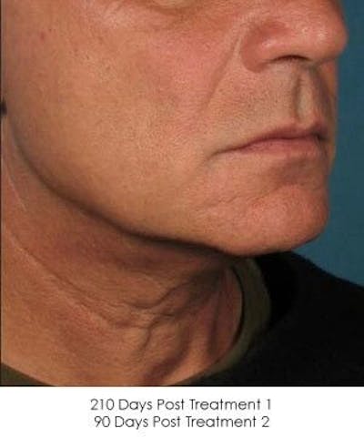 Ultherapy Before & After Gallery - Patient 55345259 - Image 2