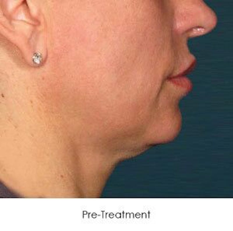 Ultherapy Gallery - Patient 55345260 - Image 1