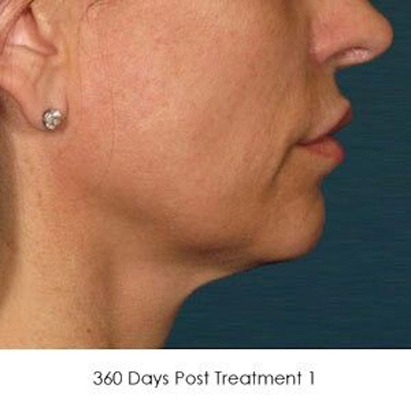 Ultherapy Gallery - Patient 55345260 - Image 2