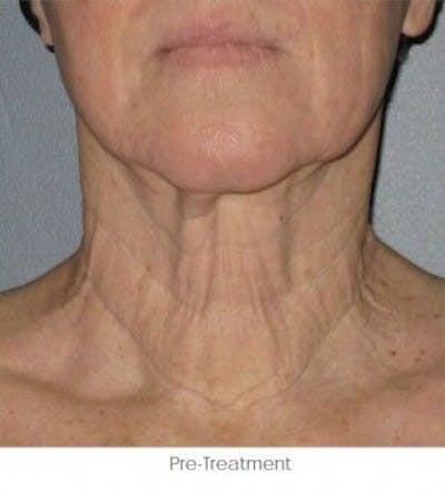 Ultherapy Before & After Gallery - Patient 55345261 - Image 1