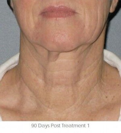 Ultherapy Before & After Gallery - Patient 55345261 - Image 2